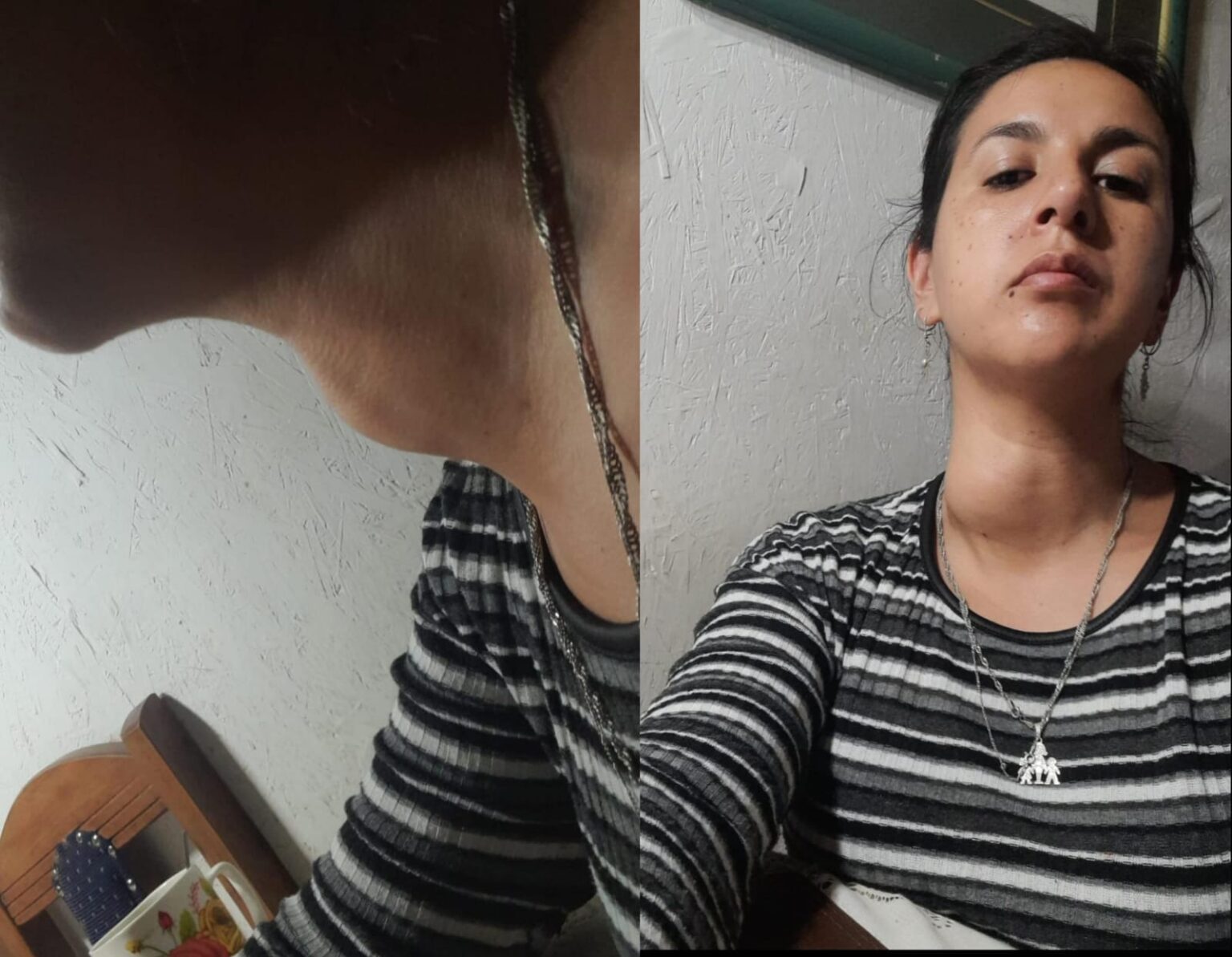 Vecina de Freire busca reunir $6 millones para urgente cirugía por nódulo